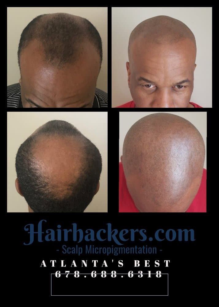 Instant Hairline - hair transplant in Sandy Springs, GA