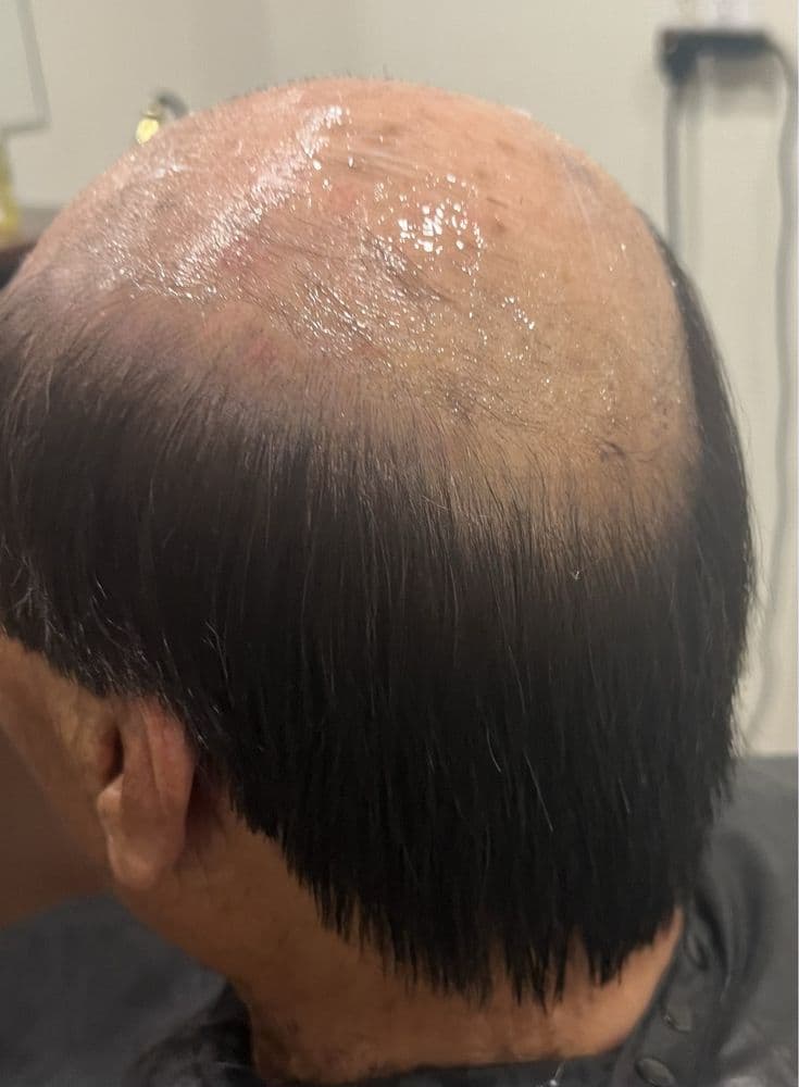 Hair Replacement Associates - hair transplant in Stoughton, MA