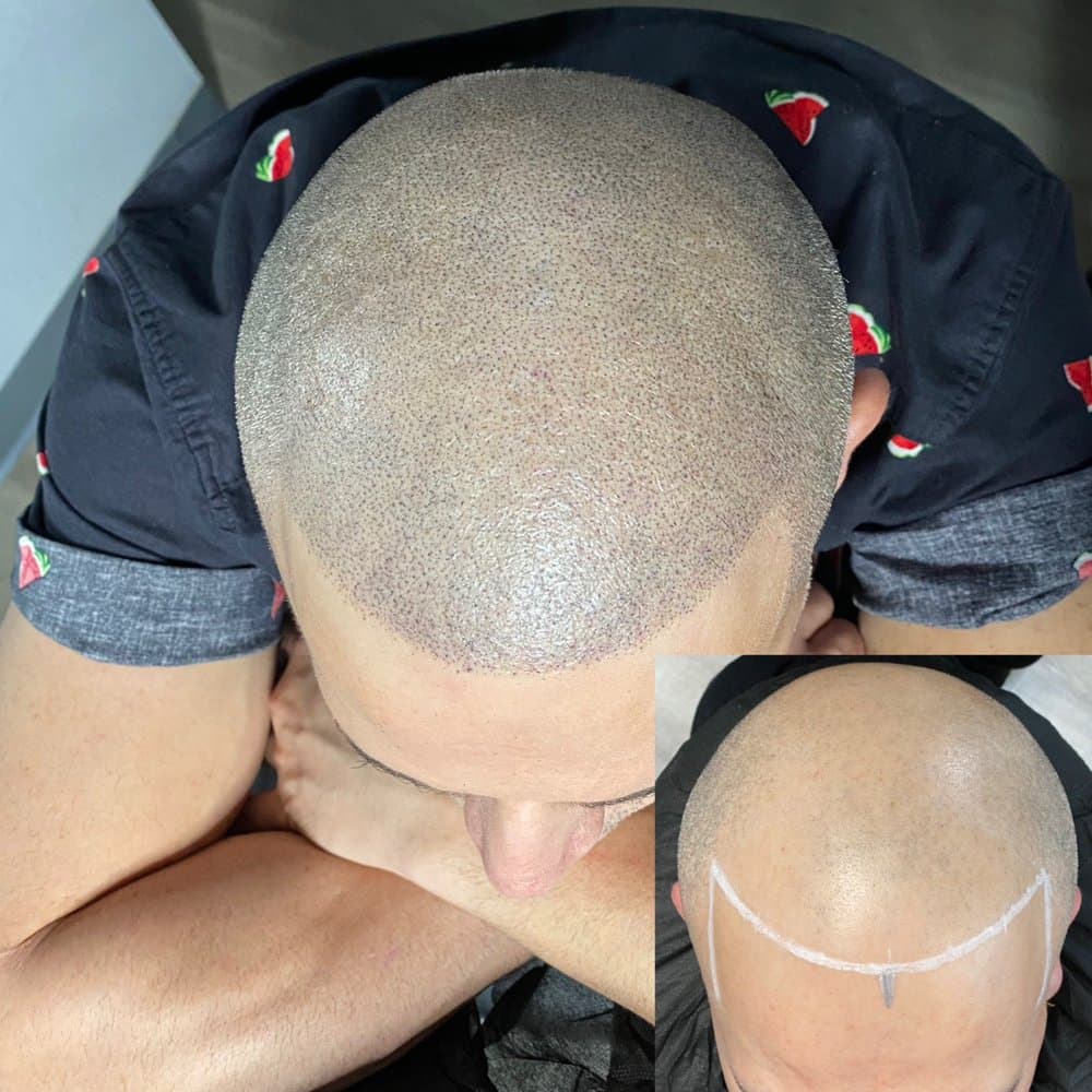 Universal Scalps - hair transplant in San Diego, CA