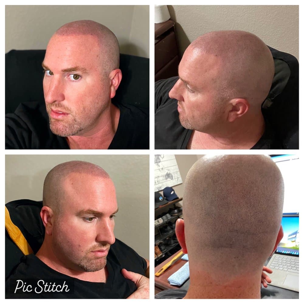 Scalp Micro USA - hair transplant in Los Angeles, CA