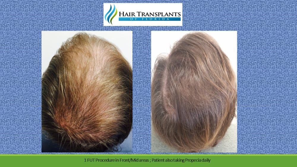 Hair Transplants of Florida - Jacksonville - hair transplant in Jacksonville, FL
