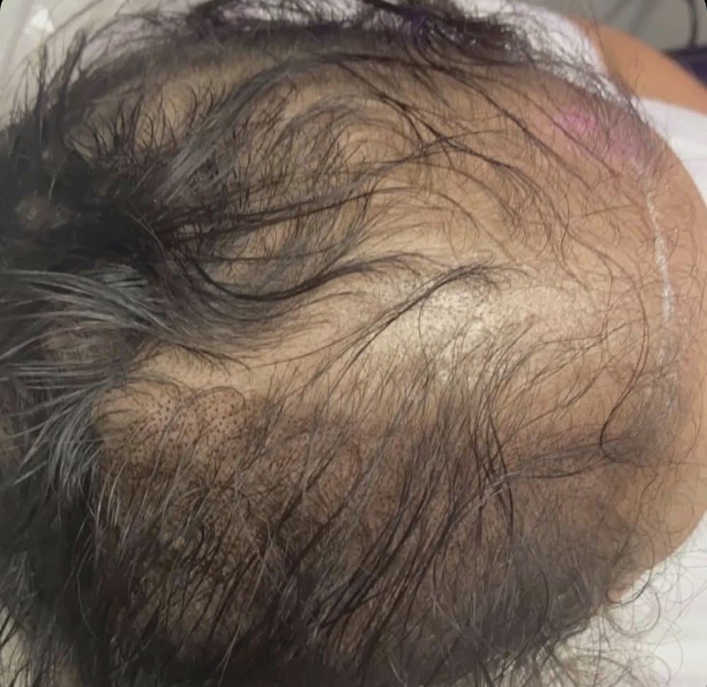 Pure Bliss Studio - hair transplant in Fort Worth, TX