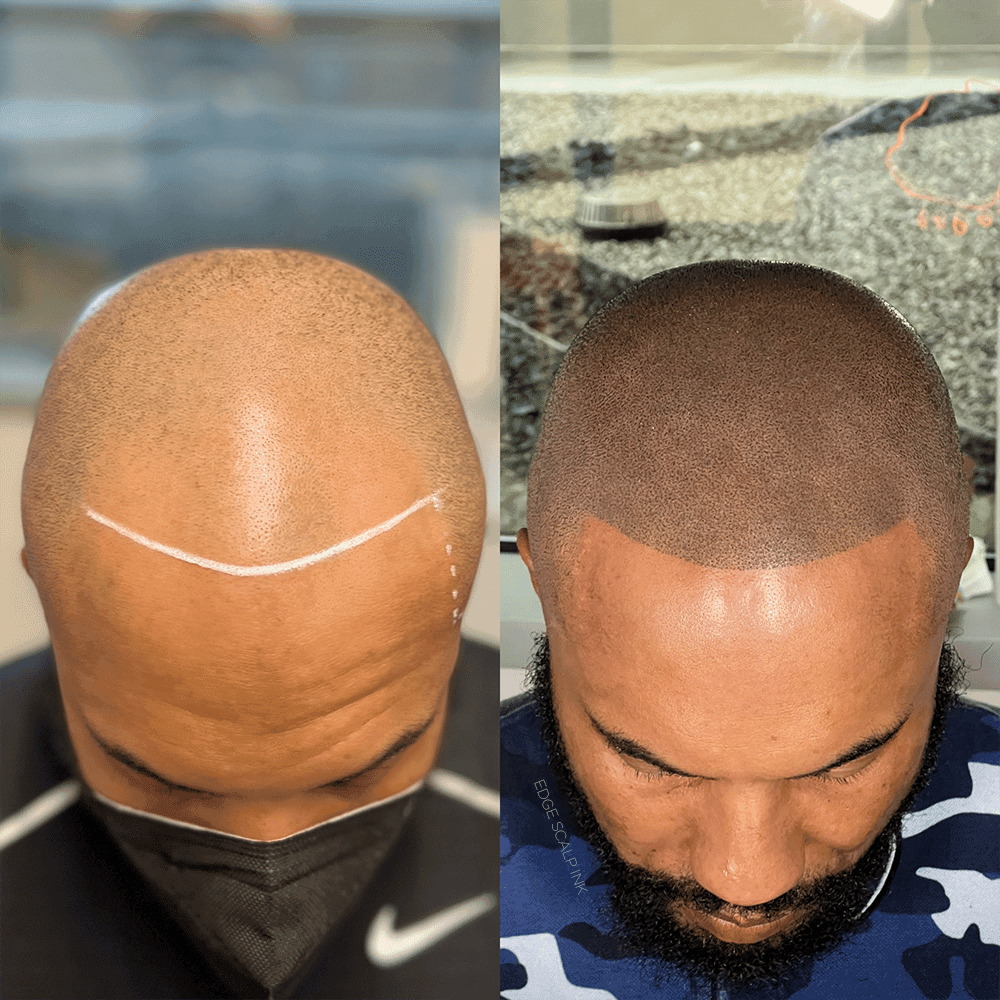 Prime Hairline - hair transplant in Wethersfield, CT