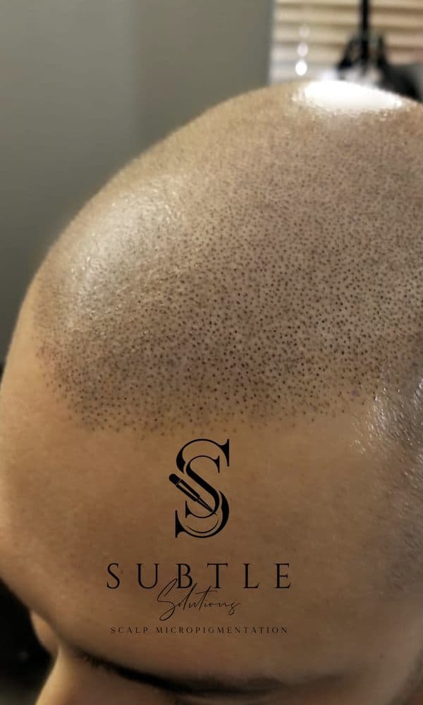 Subtle Solutions Scalp Micropigmentation - hair transplant in Phoenix, AZ