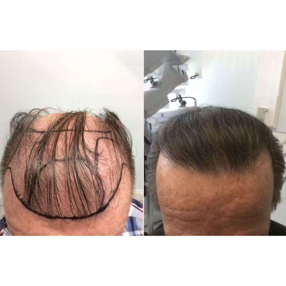Genesis Lifestyle Medicine - hair transplant in Dallas, TX