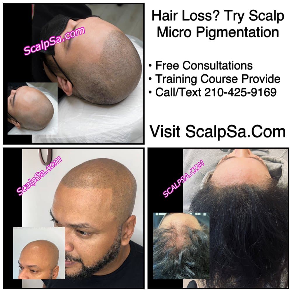 Scalpsa - hair transplant in San Antonio, TX