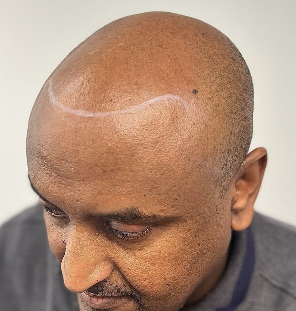 Signature SMP - hair transplant in Towson, MD
