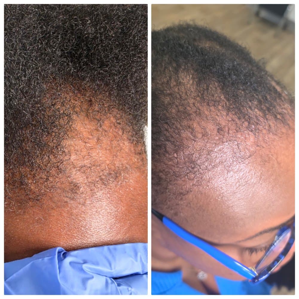 The Alopecia Doctor Hair and Scalp Spa - hair transplant in Houston, TX