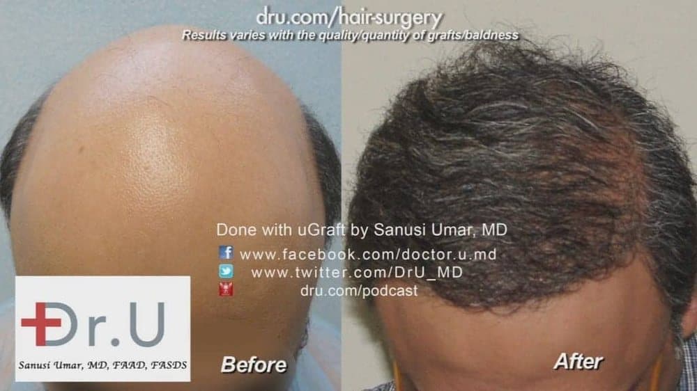Dr U Hair & Skin Clinic - hair transplant in Manhattan Beach, CA