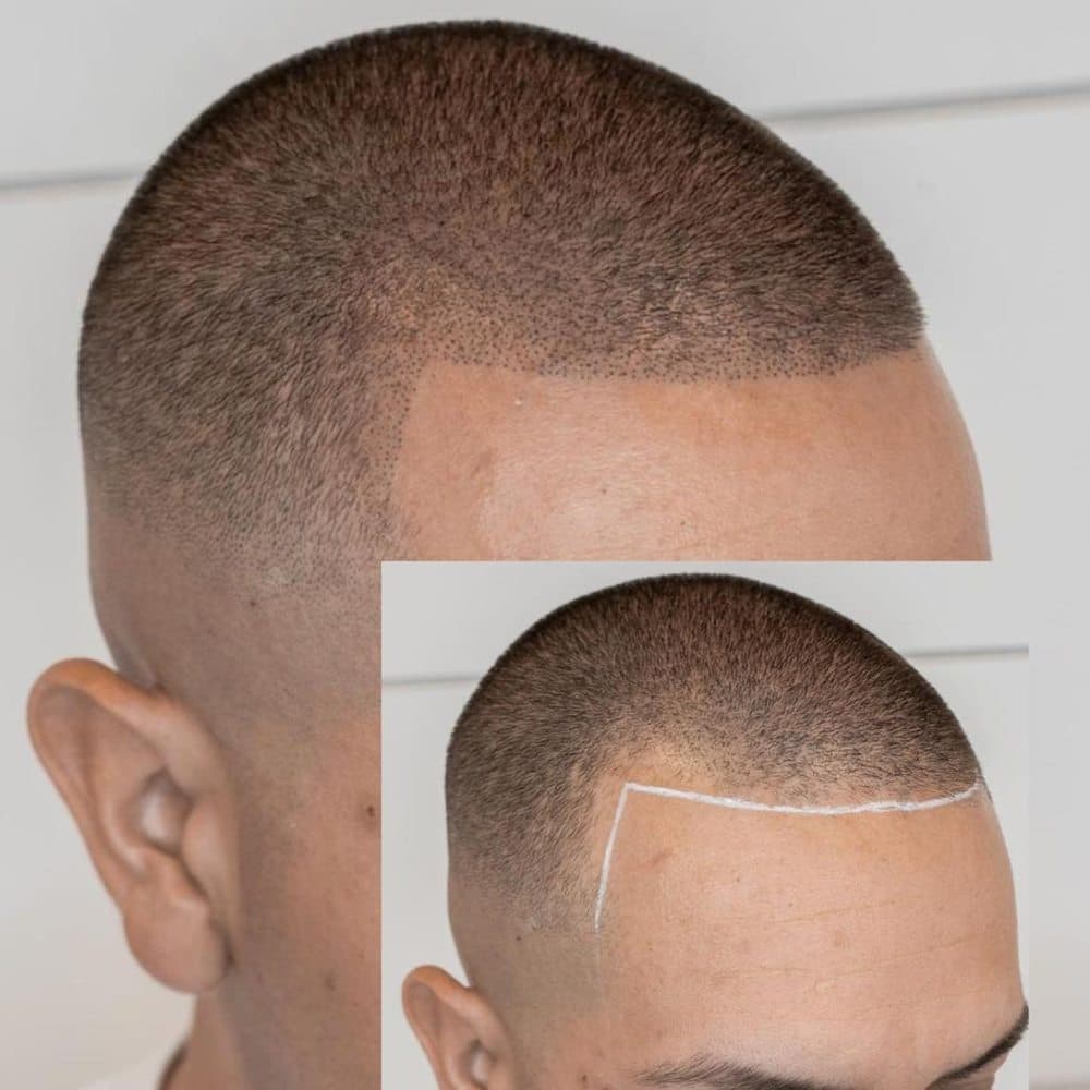 Scalp Resolution Micropigmentation - hair transplant in Johnston, RI
