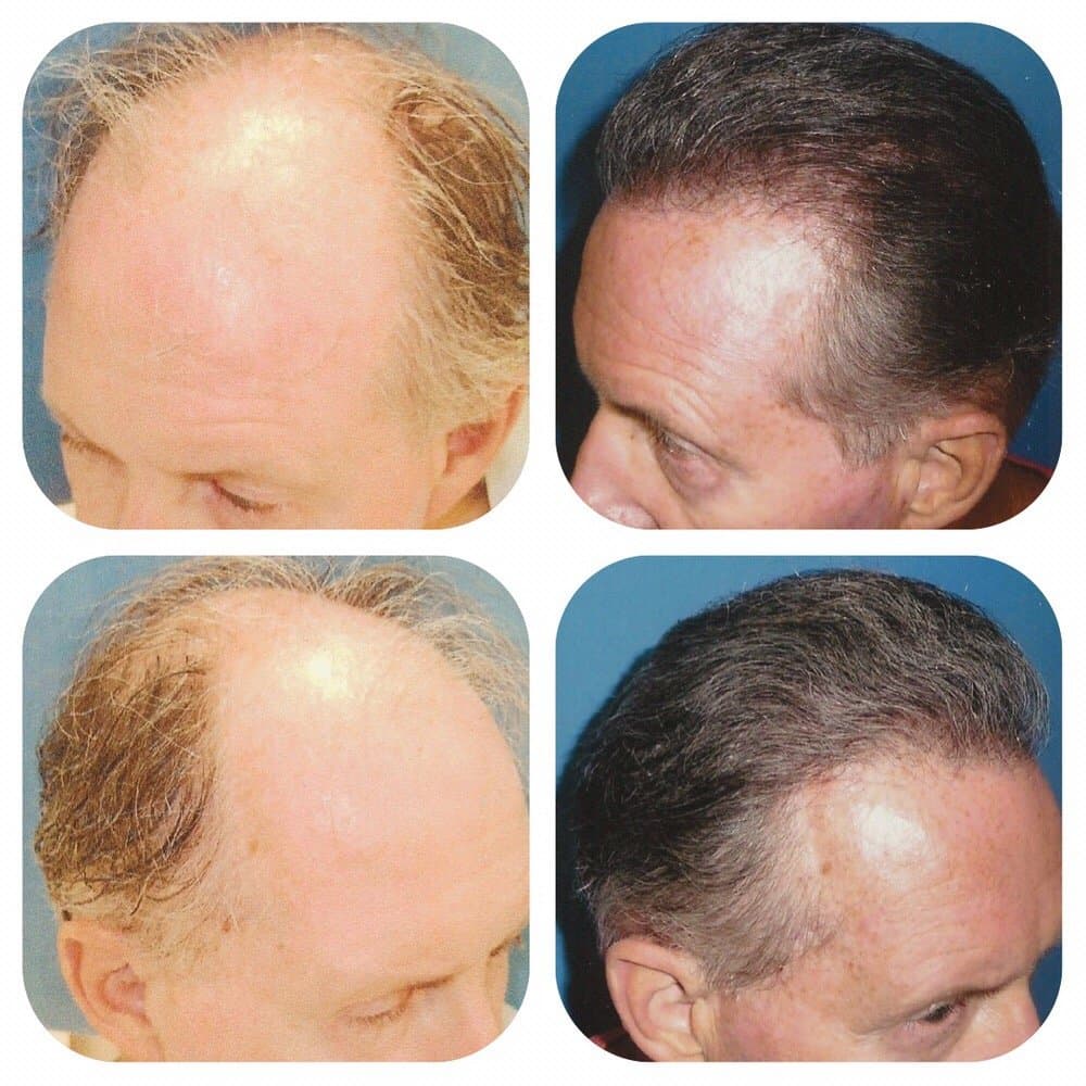 MICHAEL MESHKIN - hair transplant in Newport Beach, CA