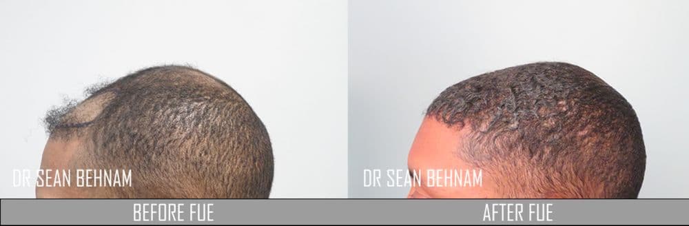 Dermatology & Hair Restoration Specialists - hair transplant in Los Angeles, CA