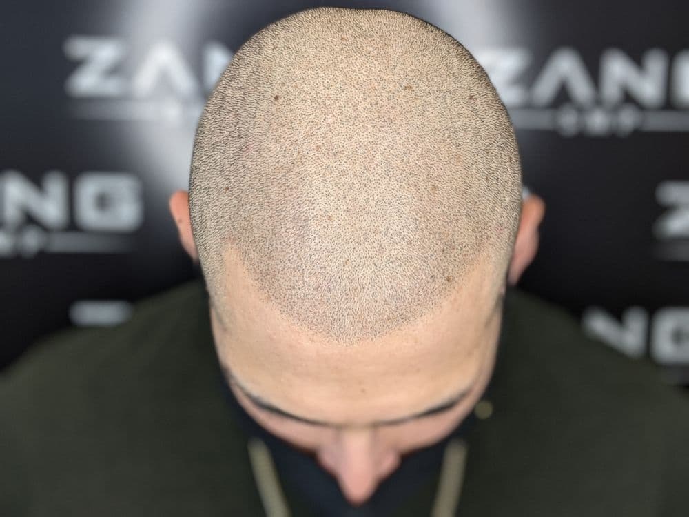 Zang SMP - hair transplant in Los Angeles, CA