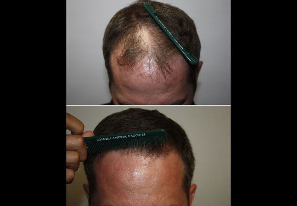 Rosanelli Medical Associates - hair transplant in San Francisco, CA