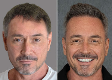 FUE Hairline Transplant Before & After - Case 3