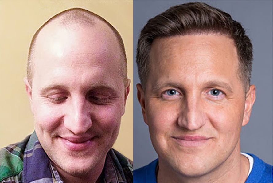 FUE Hairline Transplant Before & After - Case 4